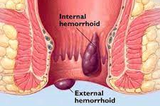 Hemorrhoidectomy