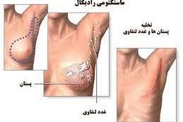 Mastectomy